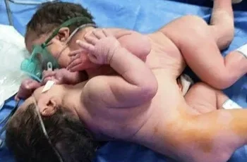 ولادة توأم ملتصق في مستشفى عام بحالة نادرة وناجحة
