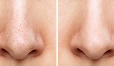 4 طرق ناجحة للتخلص من الرؤوس السوداء على الأنف